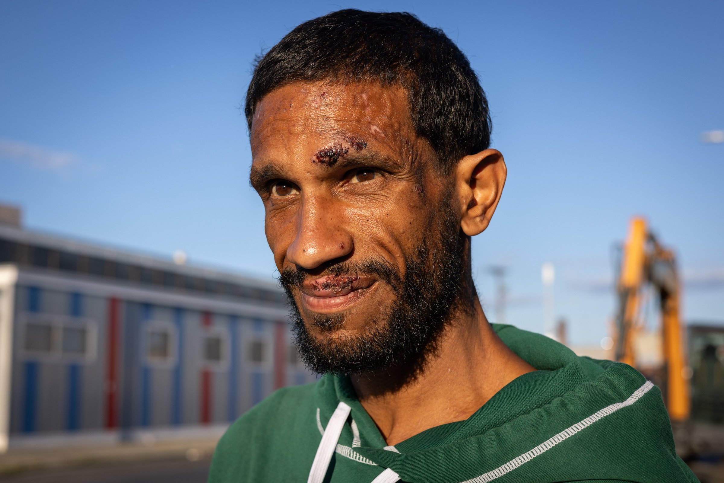 Portrait of Devin, 43, who has lived at Mass and Cass for over nine years, with facial wounds from a fall while using K2