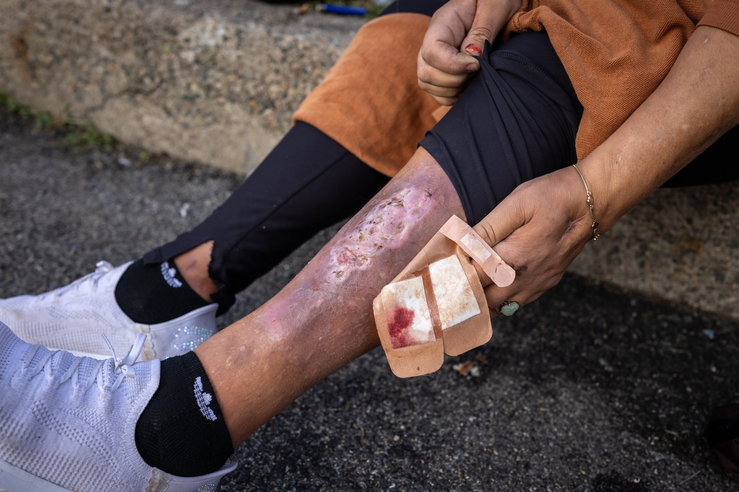 A woman at Mass and Cass lifts her pant leg to show an open wound on her calf, holding back a bled-through dressing with her own hand